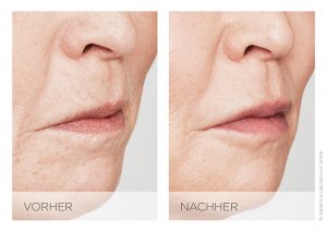 Behandlung mit Hyaluronsäure: Vorher-Nachher Bilder